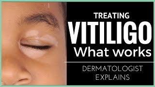 Vitiligo treatments what works [upl. by Etienne727]