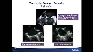 Course 13 Percutaneous Transseptal Access TMVR amp Mitral ValveinValve Replacement [upl. by Ailime]