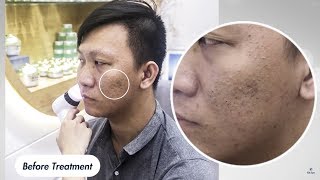 Before amp After Blackhead Removal 55min by Gà Spa  Feeling so satisfied [upl. by Stav]