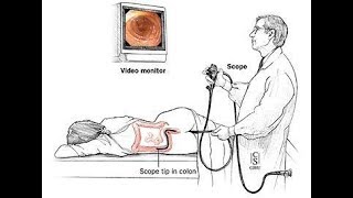 C EST QUOI UNE COLOSCOPIE  Mise à jour [upl. by Drofliw870]