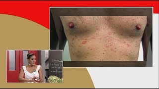 Dermatología Medidas preventivas para evitar la escabiosis [upl. by Yeznil285]