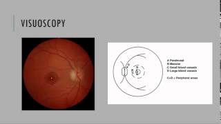 Visuoscopy Fixation Ophthalmoscopy [upl. by Iran]