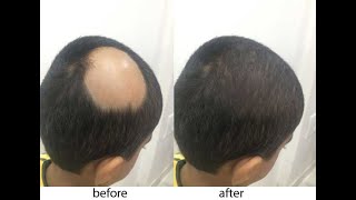 My alopecia areata recovery story [upl. by Teirtza27]