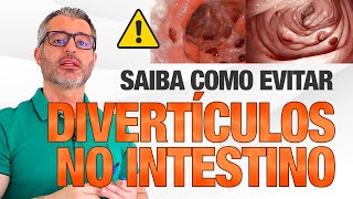 O que você precisa saber para não ter uma DIVERTICULITE [upl. by Alberta]