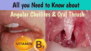 angular cheilitis  mounh ka pak jana  oral thrush  which vitamin u need in this condition [upl. by Rior253]