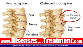 3 Osteophytes Bone Spur Causes Symptoms Diagnosis Treatment [upl. by Novyar702]