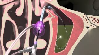 Balloon Sinuplasty Animation of the Maxillary Sinus  Seattle Sinus Surgeon [upl. by Annuahsal]