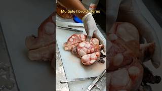 Multiple fibroid uterus specimen [upl. by Publias]