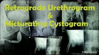 RGU MCU Retrograde Urethrogram and Micturating Cystogram Case Interpretation [upl. by Kalle882]