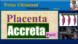 Fetus Ultrasound Placenta Accreta Part1 [upl. by Zaneski]