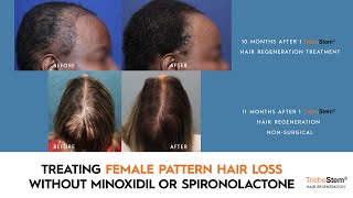 How Female Pattern Hair Loss can be Treated Without Minoxidil or Spironolactone [upl. by Oker]