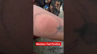 Mantoux Test Result Positive shortsyoutubeshorts virulshorts [upl. by Ettelohcin]