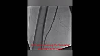 aspiration thrombectomy using the penumbra [upl. by Naehs744]