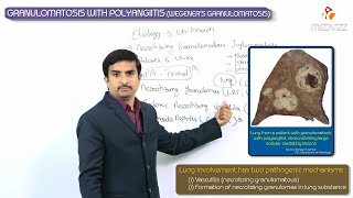 Granulomatosis with polyangiitis  Wegeners granulomatosis  Usmle step 1 vascular Pathology [upl. by Ainel]