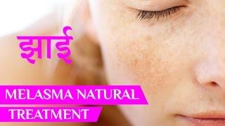 झाइयां  Melasma Treatment  pigmentation  face pigmentation  pigmentation on face  Beauty Tips [upl. by Adnaram222]