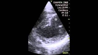 VSCAN Left ventricular aneurysm Aneurisma de ventrículo izquierdo [upl. by Amling169]