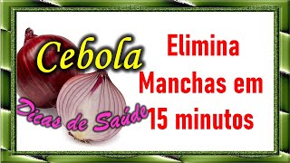 Dicas de Saúde Elimine manchas de hematomas com uma cebola em 15 minutos Rápido e Prático [upl. by Malti]