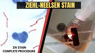 Ziehl Neelsen StainAcid Fast StainZN StainZiehl Neelsen Stain ProcedureAdnanMLT [upl. by Stav]