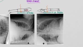 CXR Pleural effusions [upl. by Adnael]