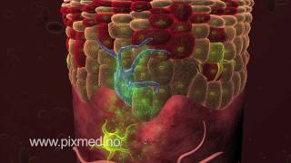 3D MEDICAL ANIMATION Actinic Keratosis  Pixmed [upl. by Gaige]