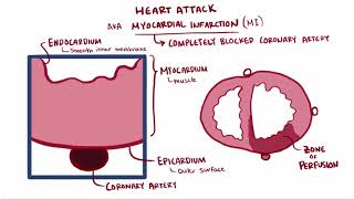 Heart attack acute myocardial infarction causes symptoms diagnosis treatment pathology [upl. by Yeltrab]