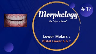 Morphology  17  Distal Aspect Of Lower Molars  Lower 6 amp 7 [upl. by Meeka]