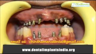 Teeth Restoration Chennai  Full Mouth Reconstruction India [upl. by Ellennaj]