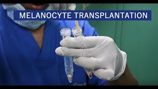 Melanocyte Transplantation For Vitiligo in Delhi India 2023  Care Well Medical Centre [upl. by Brenden680]