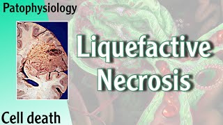 Pathophysiology  Liquefactive Necrosis Hani Laith شرح [upl. by Jaclin]