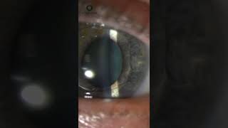 Iris Claw Lens Implant [upl. by Nnauol]