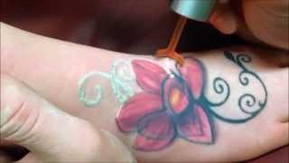 PicoWay eliminar tatuajes con láser [upl. by Ketchan]