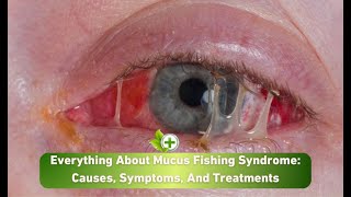 Mucus Fishing Syndrome [upl. by Desai]