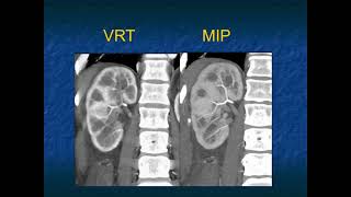 The Differential Diagnosis of Loss of Renal Corticomedullary Interface  Part 1 [upl. by Morry]