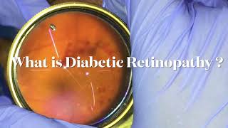 What is Diabtetic Retinopathy by Dr Anuj Soni [upl. by Fernandina]