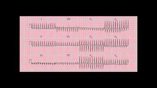 Reading the 12lead ECGEKG  six quick steps [upl. by Nitsirc]