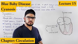 Cyanosis  Blue baby  Cardiovascular disorders  Chapter Circulation video 15 [upl. by Syst]