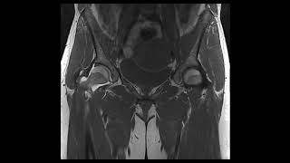 Hip Labral Tear [upl. by Ttehc188]