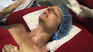 IPL Treatment Recovery amp Results  Makeover First Stage [upl. by Naujad]