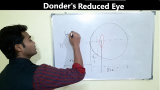 Donders reduced eye [upl. by Cassil597]