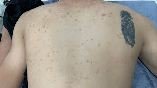 ACNE TREATMENT VU QUYNH MI Acne On Boys Back 2024 [upl. by Brunhilda]