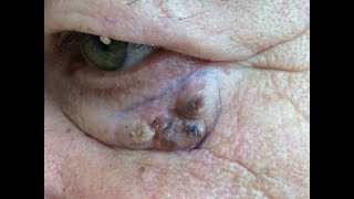 Basal Cell Carcinoma  Face Skin Cancer [upl. by Jeremias]