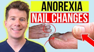 6 finger nail changes seen in ANOREXIA  Doctor explains [upl. by Newmann558]