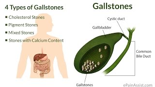 Drinking apple cider to flush out gall bladder stones ENG SUB [upl. by Draper526]