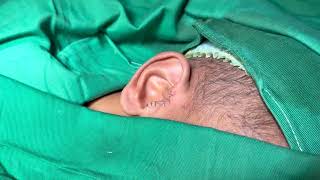 Preauricular ear tag excision in Sri Lanka Dr S B Etulgama ENT Surgeon [upl. by Eidnac]