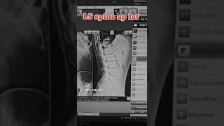 X ray ls spine ap lat anatomy medicalimaging science xraytechnician xrayart xraytechnologis [upl. by Flann]