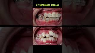 Braces evolution  2 years braces orthodontist dentist [upl. by Dave]