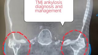 PART 1 TM joint ankylosis in a young boy Diagnosis Investigation and Management [upl. by Adlih]