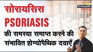 सोरायसिस  Psoriasis  Natural Homeopathic remedies with Symptoms  होम्योपैथिक उपचार [upl. by Onailil]