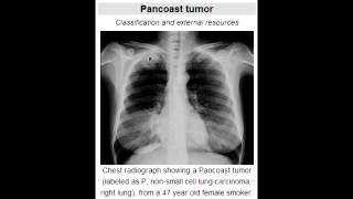 Pancoast Tumor of the Lung and What all it can compress [upl. by Mchugh]