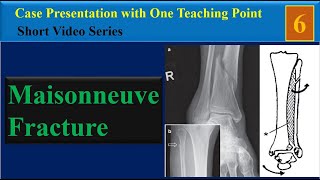 Maisonneuve Fracture Case Presentation with One Teaching Point [upl. by Yseulta489]